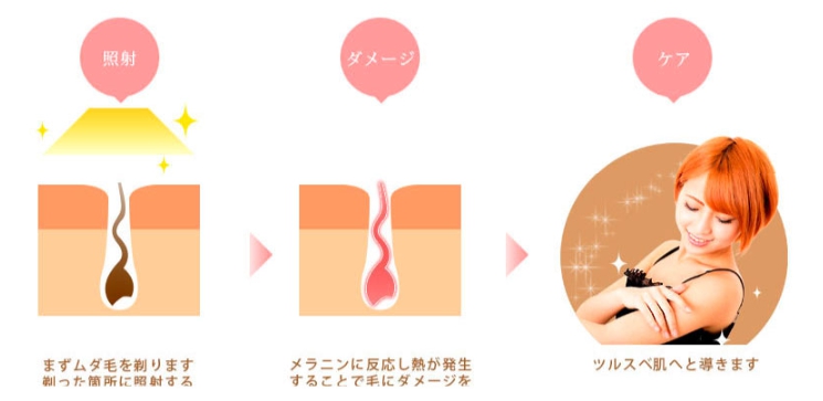 IPL脱毛