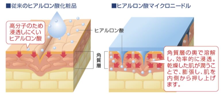 マイクロニードル