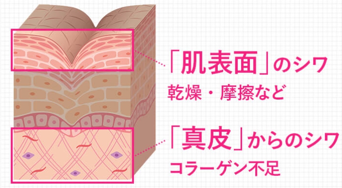 シワ
